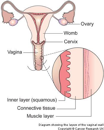 Enfermedad intraepitelial de cervix, vagina y vulva.