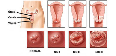 Enfermedad intraepitelial de cervix, vagina y vulva.