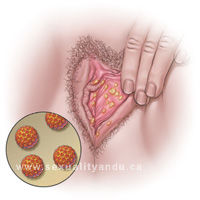 Enfermedad intraepitelial de cervix, vagina y vulva.
