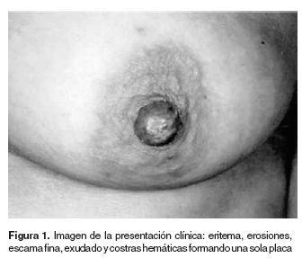 Enfermedades Beningnas de la Mama