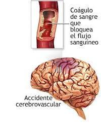 ACCIDENTE CEREBRO VASCULAR