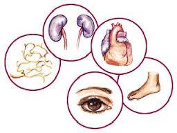 Diabetes mellitus (etiología)