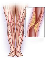 Diabetes mellitus (prevención)