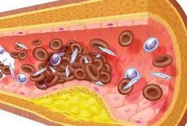 Diabetes mellitus (prevención)