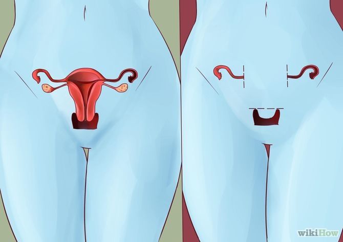 Endoscopia e histerectomia