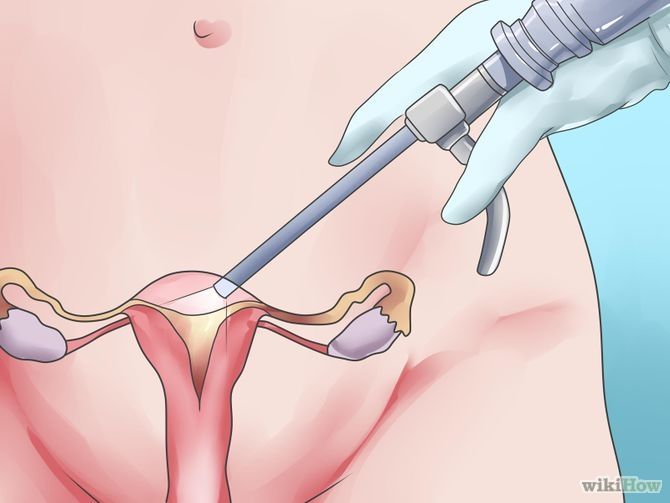 Endoscopia e histerectomia