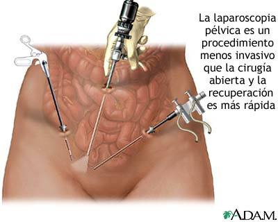 Endoscopia e histerectomia