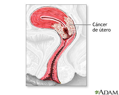 Endoscopia e histerectomia