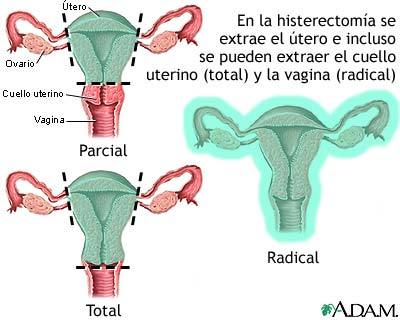 Endoscopia e histerectomia