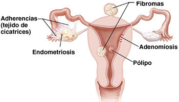 Endoscopia e histerectomia