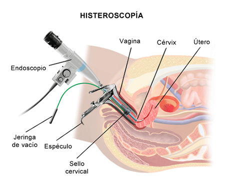 Endoscopia e histerectomia