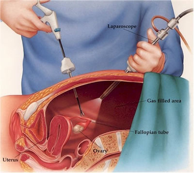Endoscopia e histerectomia