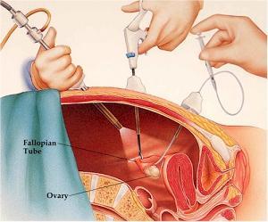 Endoscopia e histerectomia