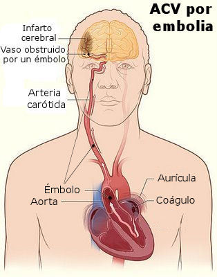 ECV