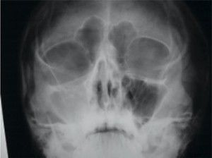 Rádioproteção, dose e risco em exames radiográficos nos seios das faces de crianças, em hospitais de Belo Horizonte