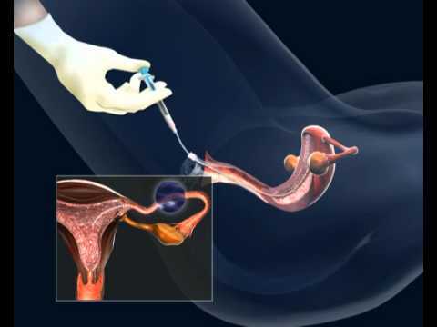 Reproduccion Asistida Y Inseminacion Artificial