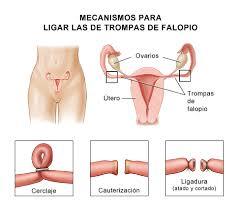 Anticoncepción médica, métodos mecánicos y quirúrgicos