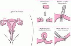 Anticoncepción médica, métodos mecánicos y quirúrgicos