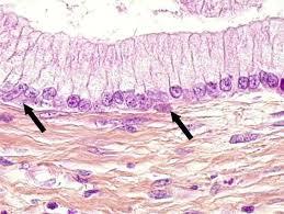 Enfermedad intraepitelial de cervix, vagina y vulva