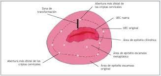 Enfermedad intraepitelial de cervix, vagina y vulva