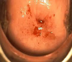 Enfermedad intraepitelial de cervix, vagina y vulva