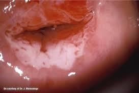 Enfermedad intraepitelial de cervix, vagina y vulva