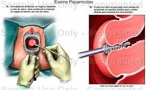 Enfermedad intraepitelial de cervix, vagina y vulva