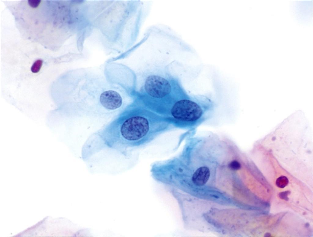 Enfermedad intraepitelial de cervix, vagina y vulva