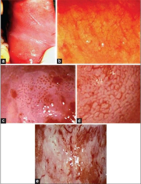 Enfermedad intraepitelial de cervix, vagina y vulva