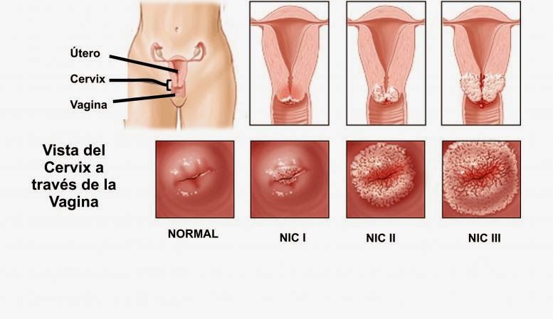 Enfermedad intraepitelial de cervix, vagina y vulva