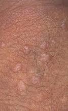 Enfermedad intraepitelial de cervix, vagina y vulva