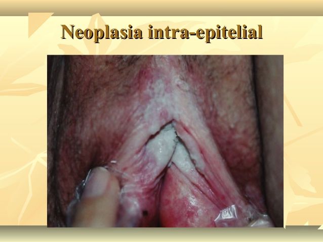 Enfermedad intraepitelial de cervix, vagina y vulva