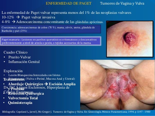Enfermedad intraepitelial de cervix, vagina y vulva