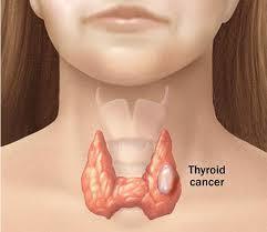 CÁNCER DE TIROIDES