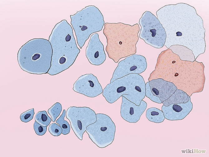 Cáncer Invasor de Cérvix y vagina