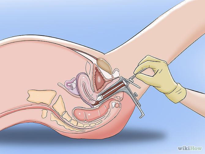 Cáncer Invasor de Cérvix y vagina