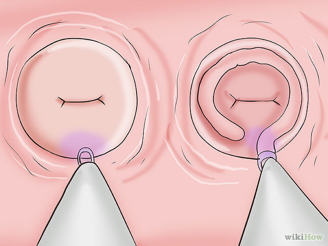 Cáncer Invasor de Cérvix y vagina