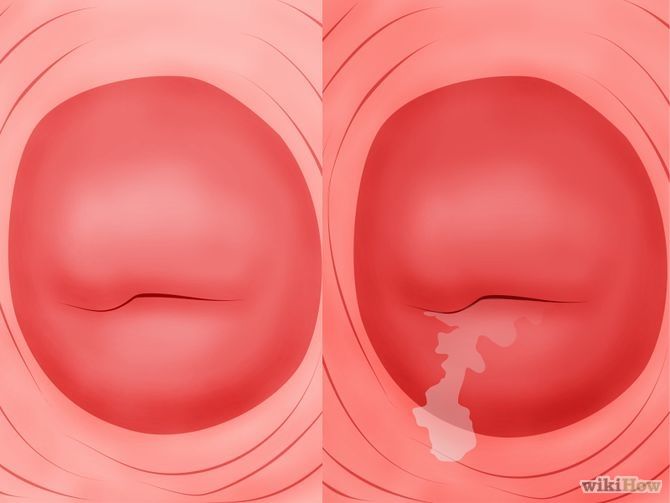Cáncer Invasor de Cérvix y vagina