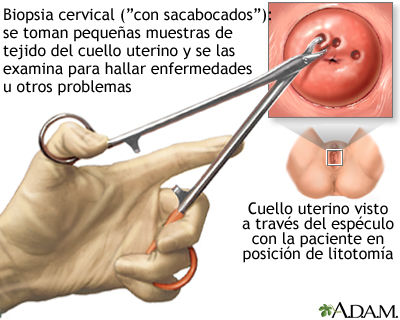 Cáncer Invasor de Cérvix y vagina