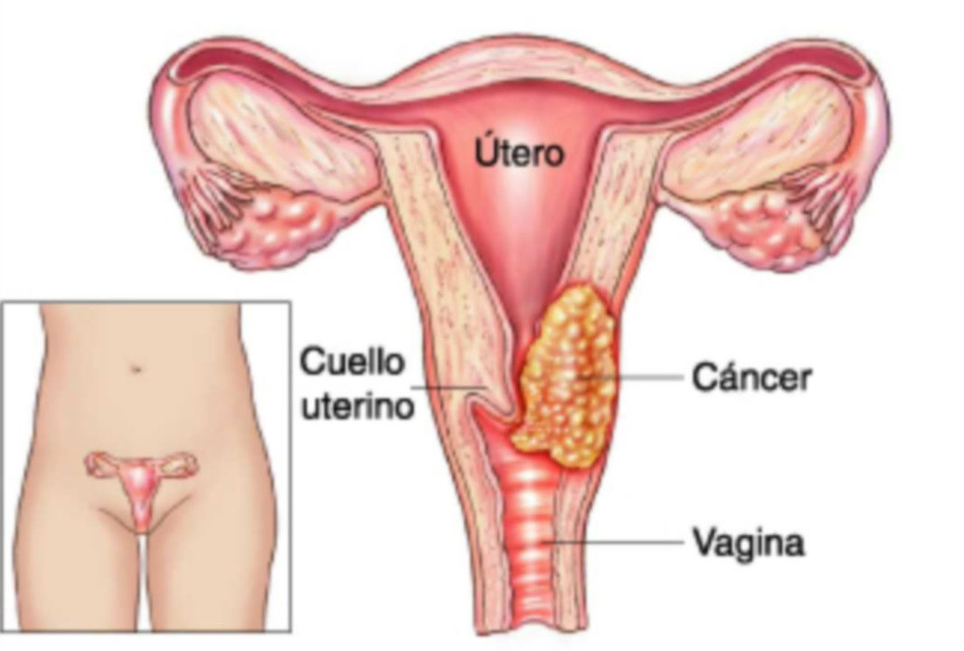 Cáncer Invasor de Cérvix y vagina