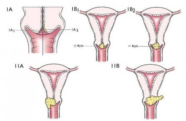 Cáncer Invasor de Cérvix y vagina