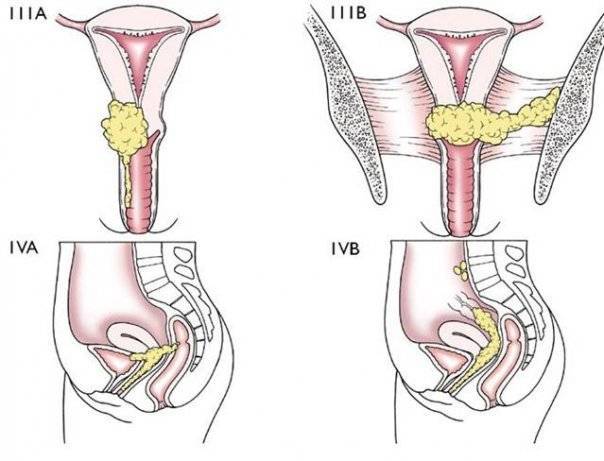 Cáncer Invasor de Cérvix y vagina
