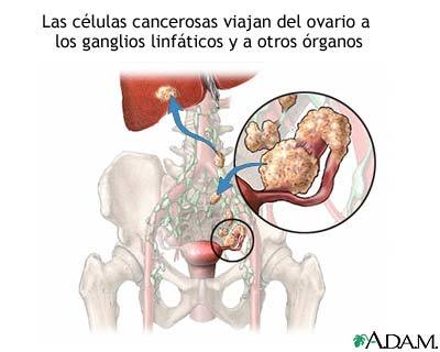 Cáncer de Ovário