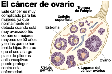 Cáncer de Ovário