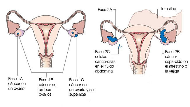 Cáncer de Ovário