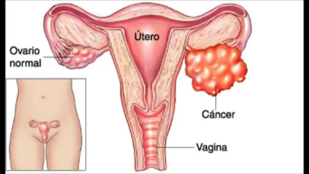 Cáncer de Ovário