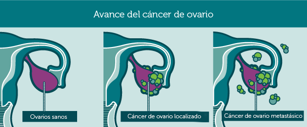 Cáncer de Ovário