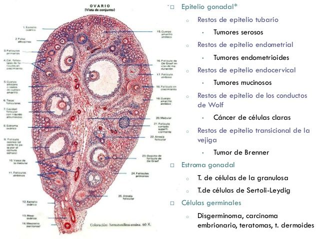 Cáncer de ovario