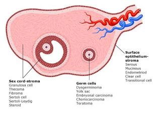 Cáncer de ovario
