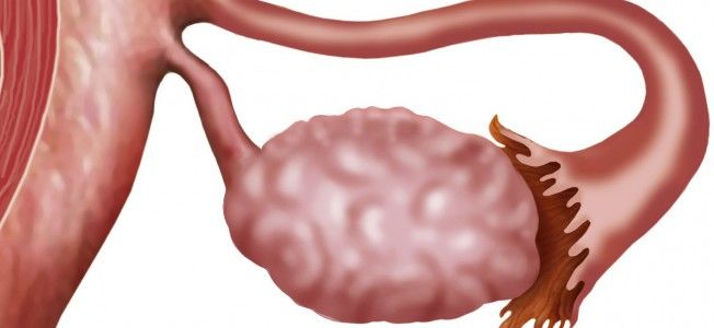 Cáncer de ovario